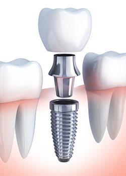 Implant dentaire Rennes